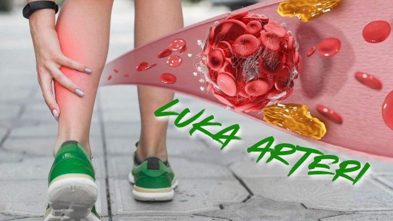 Luka Arteri Akibat Kolesterol Tinggi: Waspadai Luka Kronis | RUMAT